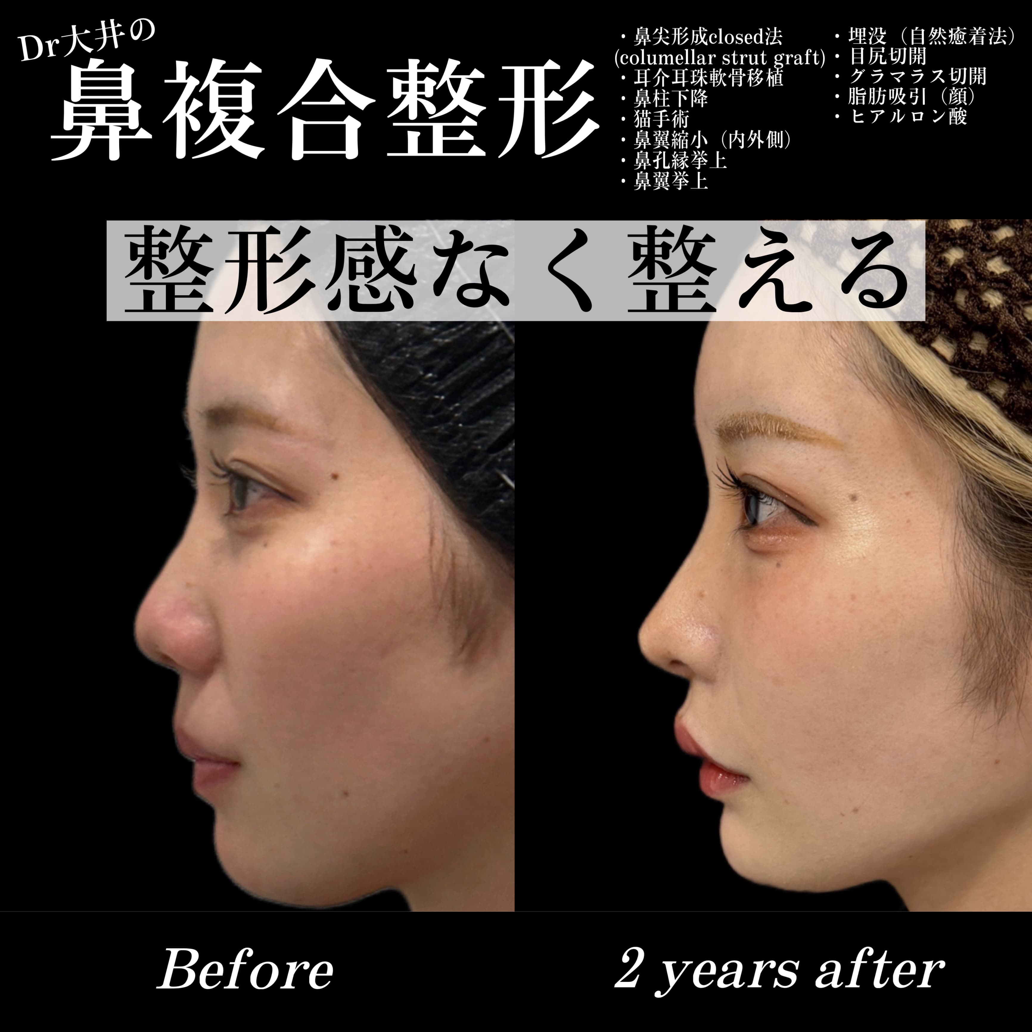 鼻複合整形 整形感なく整える(鼻尖形成closed法(columellar strut graft)・プロテーゼ・耳介耳珠軟骨移植・鼻柱下降・猫手術・鼻翼縮小(内外側)・鼻翼拳上・鼻孔縁挙上)・埋没(自然癒着法)・目尻切開・グラマラス切開・脂肪吸引(顔)・ヒアルロン酸)