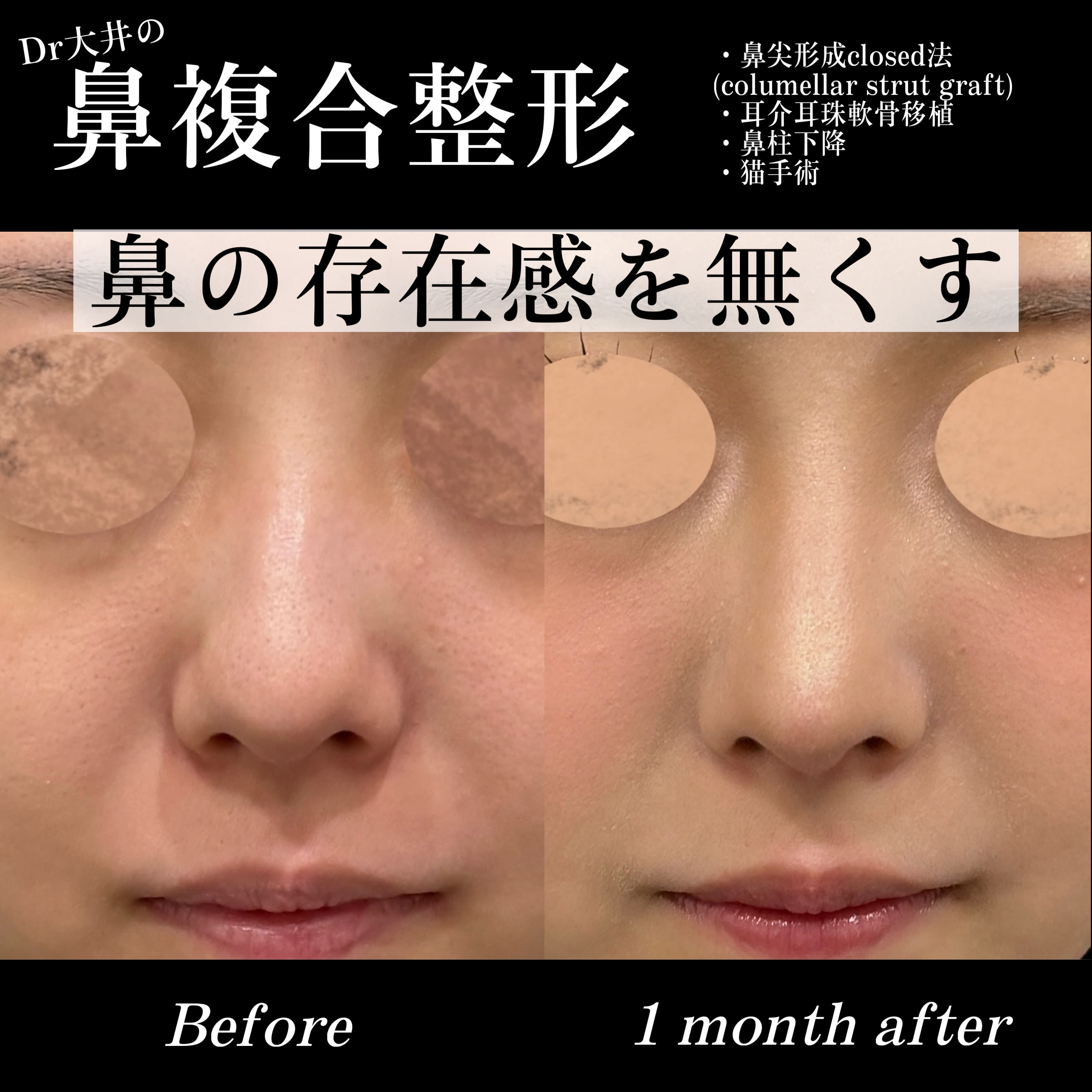鼻複合整形 鼻の存在感を無くす(鼻尖形成closed法(columellar strut graft)・耳介耳珠軟骨移植・鼻柱下降・猫手術)