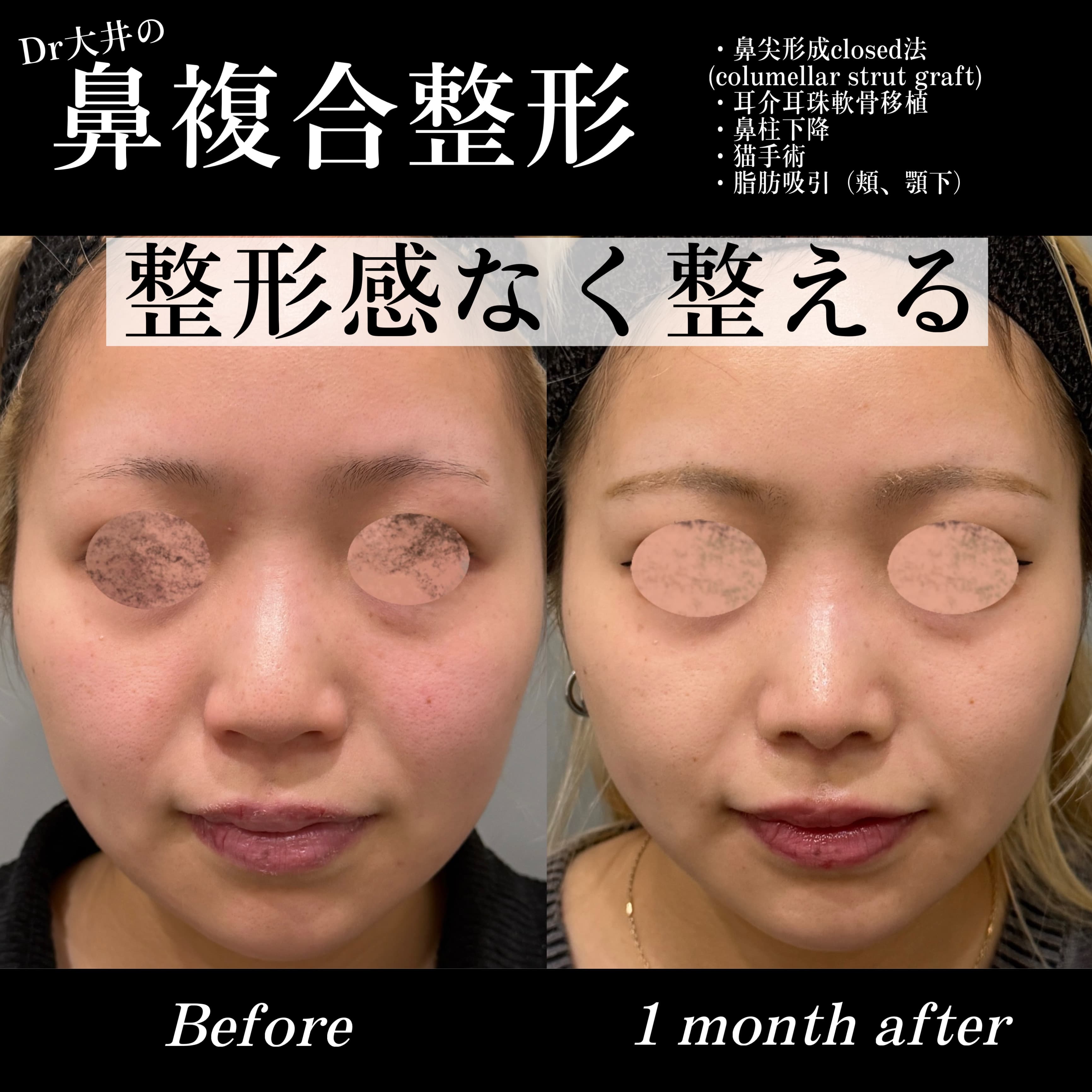 鼻複合整形 整形感なく整える(鼻尖形成closed法(columellar strut graft)・耳介耳珠軟骨移植・鼻柱下降・猫手術・脂肪吸引(頬、顎下))