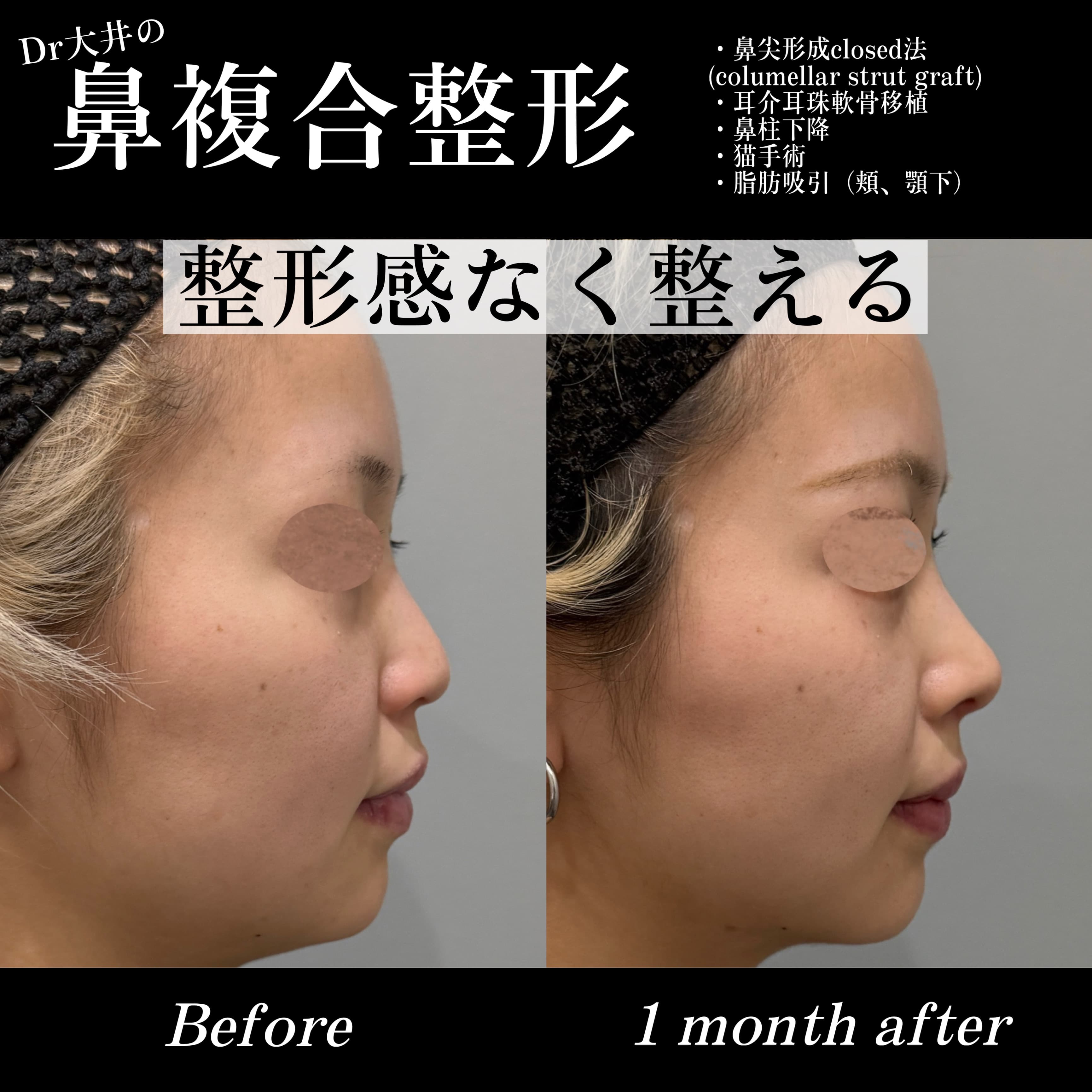 鼻複合整形 整形感なく整える(鼻尖形成closed法(columellar strut graft)・耳介耳珠軟骨移植・鼻柱下降・猫手術・脂肪吸引(頬、顎下))