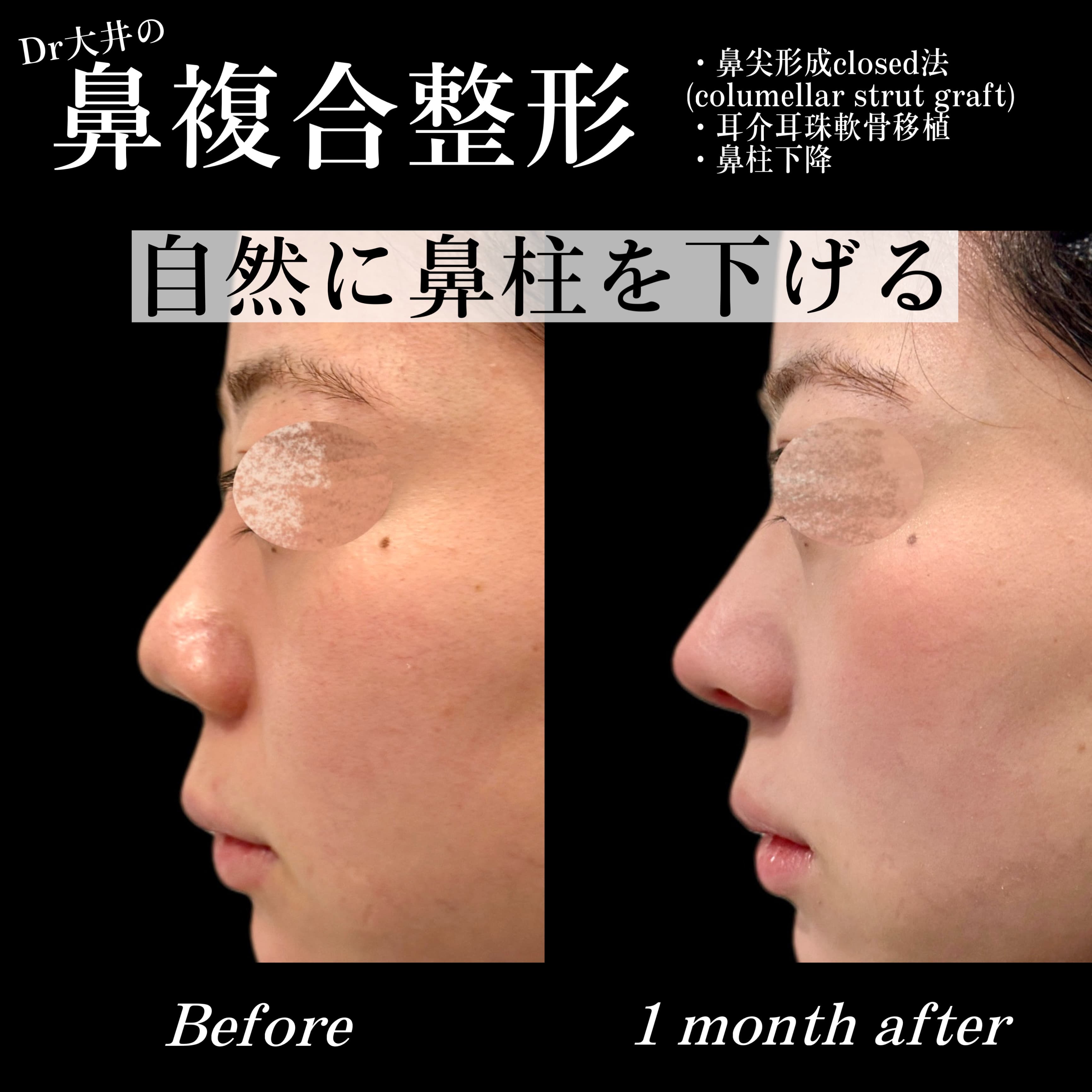 鼻複合整形 自然に鼻柱を下げる(鼻尖形成・耳介耳珠軟骨移植・鼻柱下降) Before/After