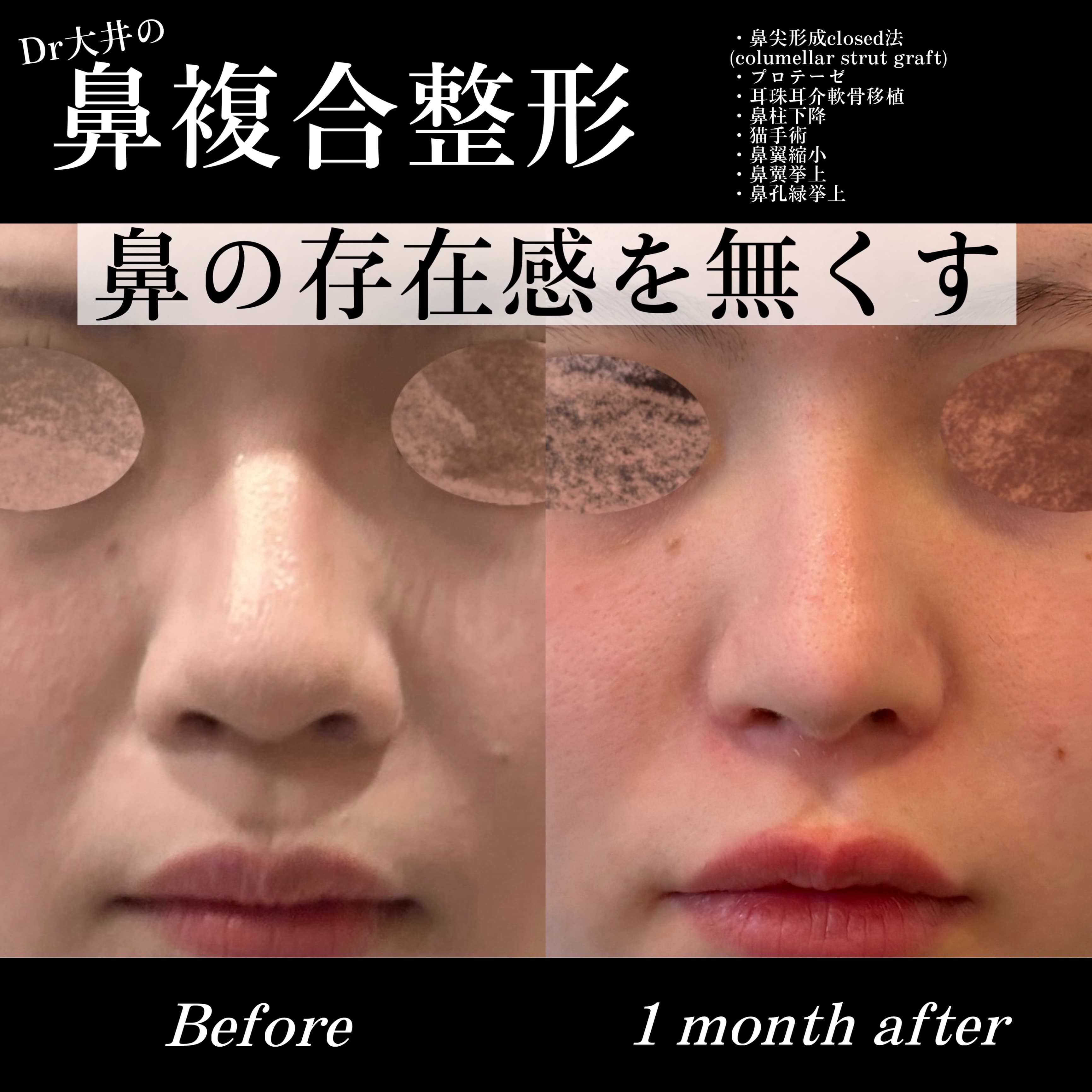 鼻複合整形 鼻の存在感を無くす(鼻尖形成closed法(columellar strut graft)・プロテーゼ・耳介耳珠軟骨移植・鼻柱下降・猫手術・鼻翼縮小・鼻翼拳上・鼻孔縁挙上)